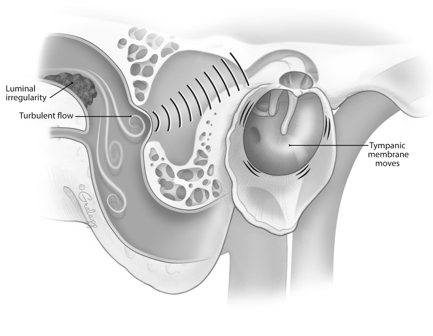 Pulsatile Tinnitus