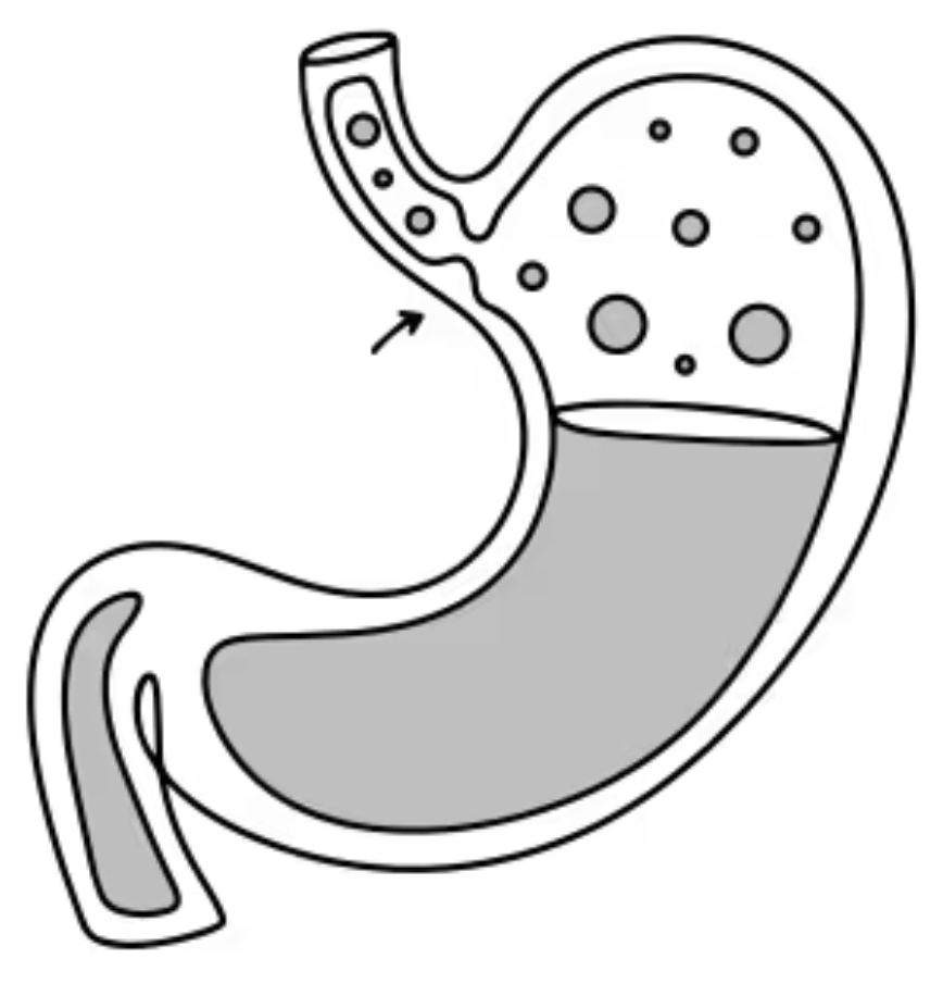 GERD and Hiatal Hernias