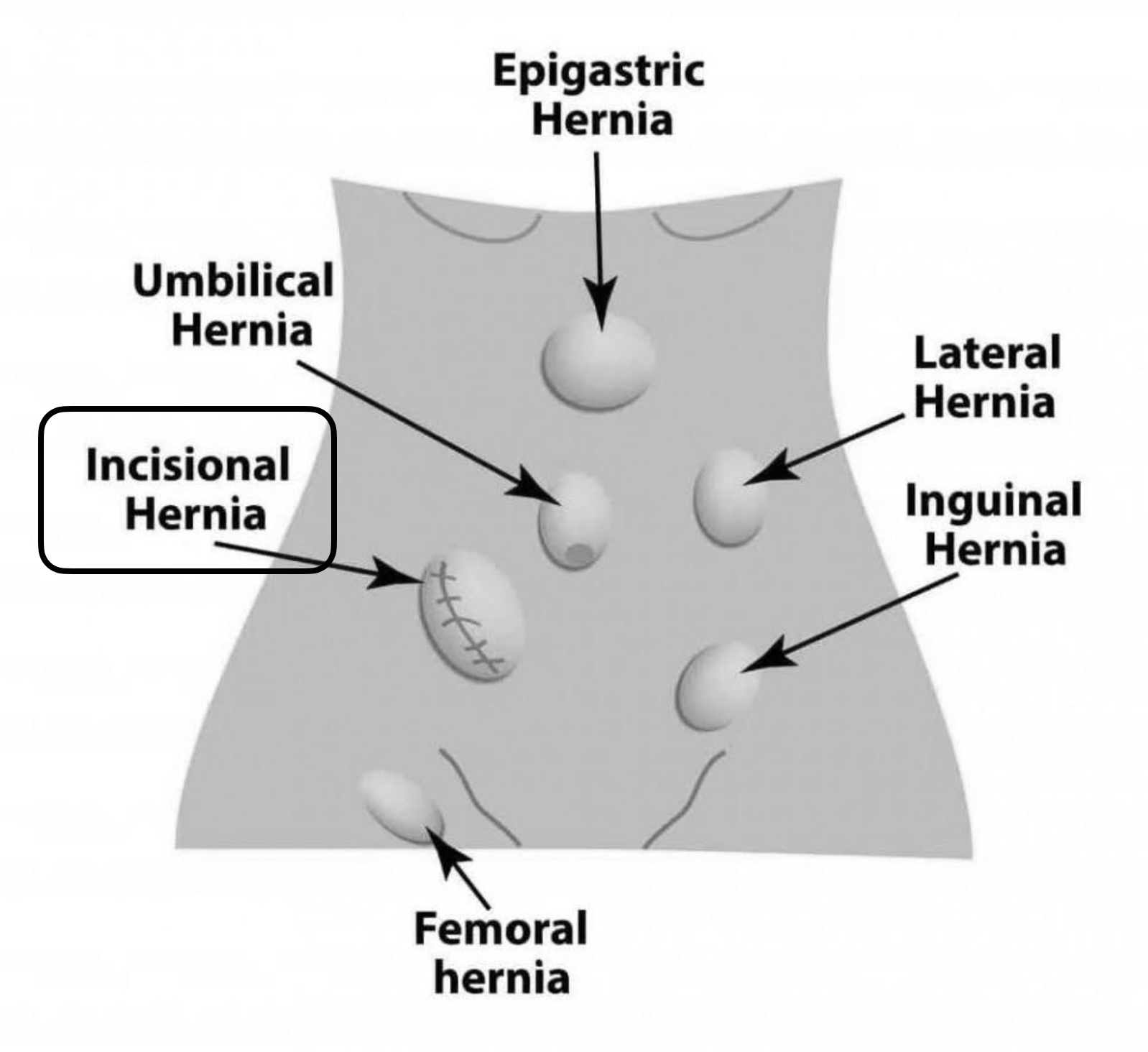 Abdominal Wall Hernias