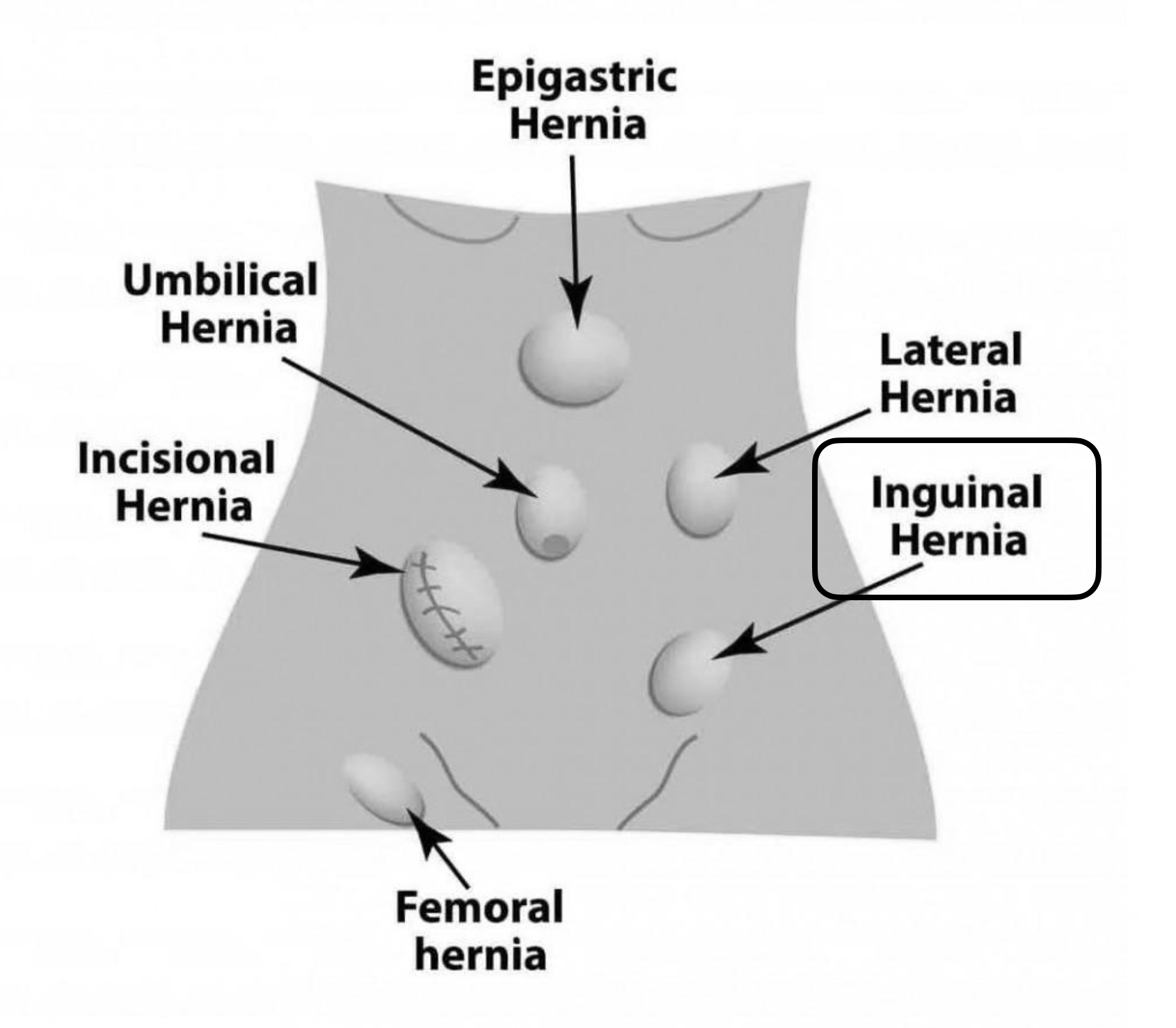 Groin Hernias